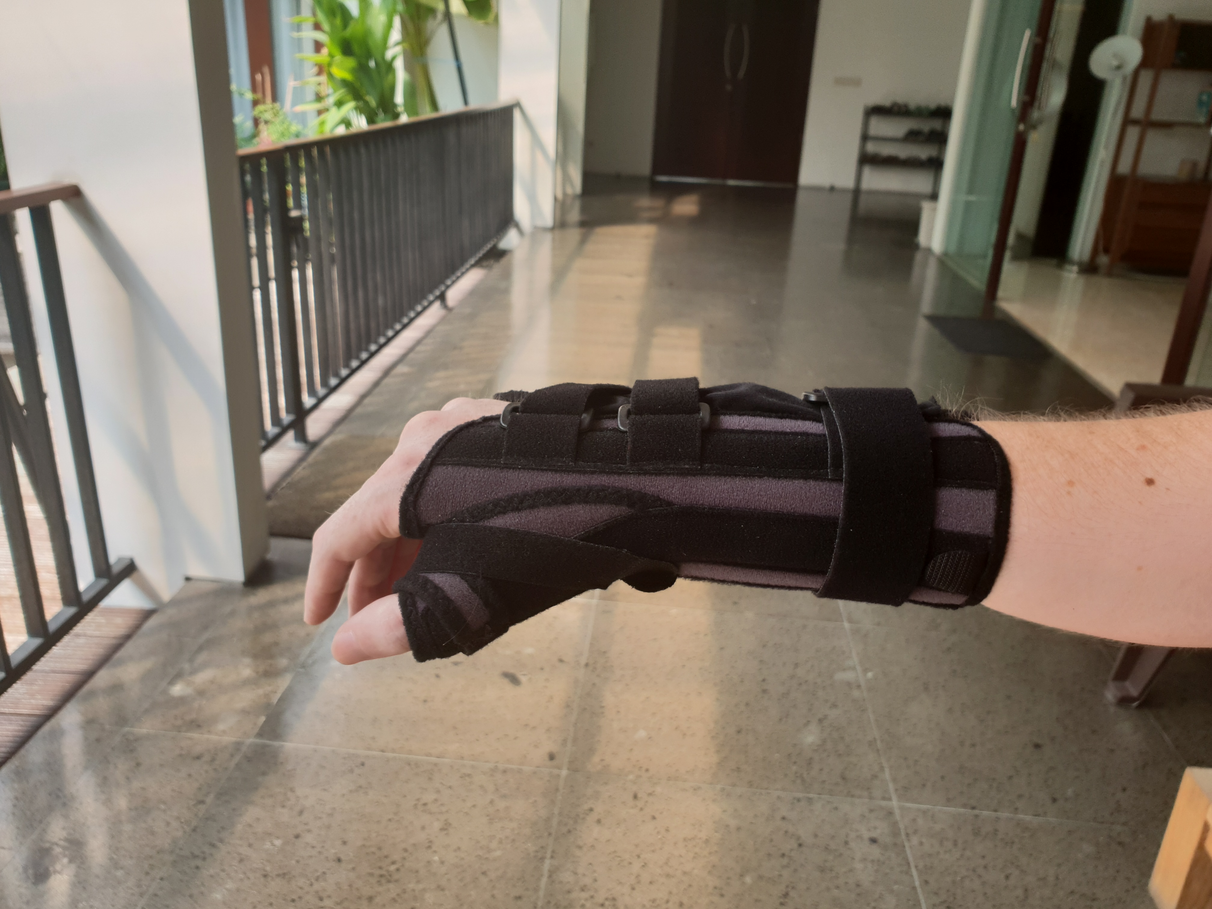 The same hand, in the Mediroyal brace The same hand, in the Mediroyal brace