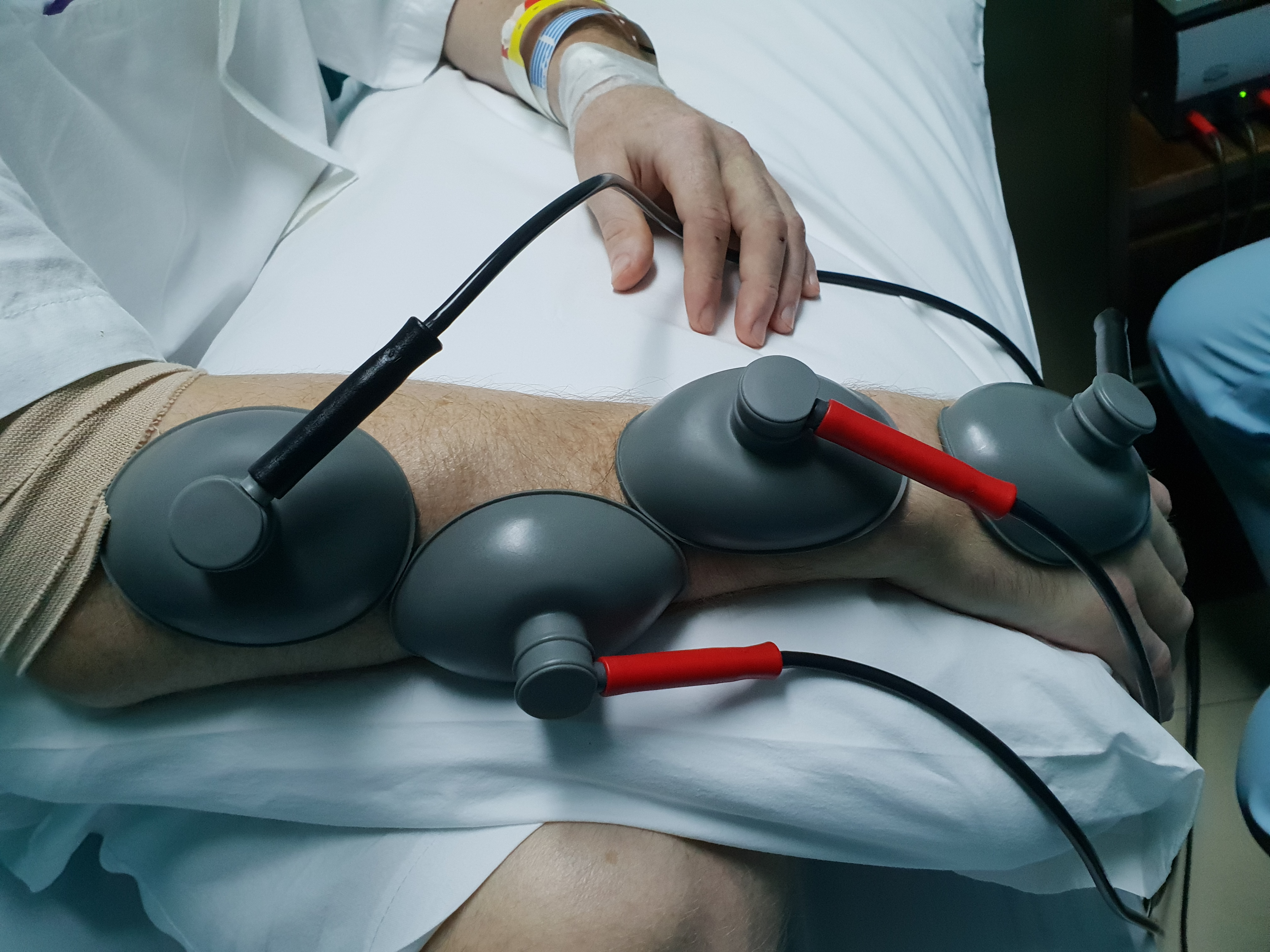 Electrical stimulation started the next morning Electrical stimulation started the next morning