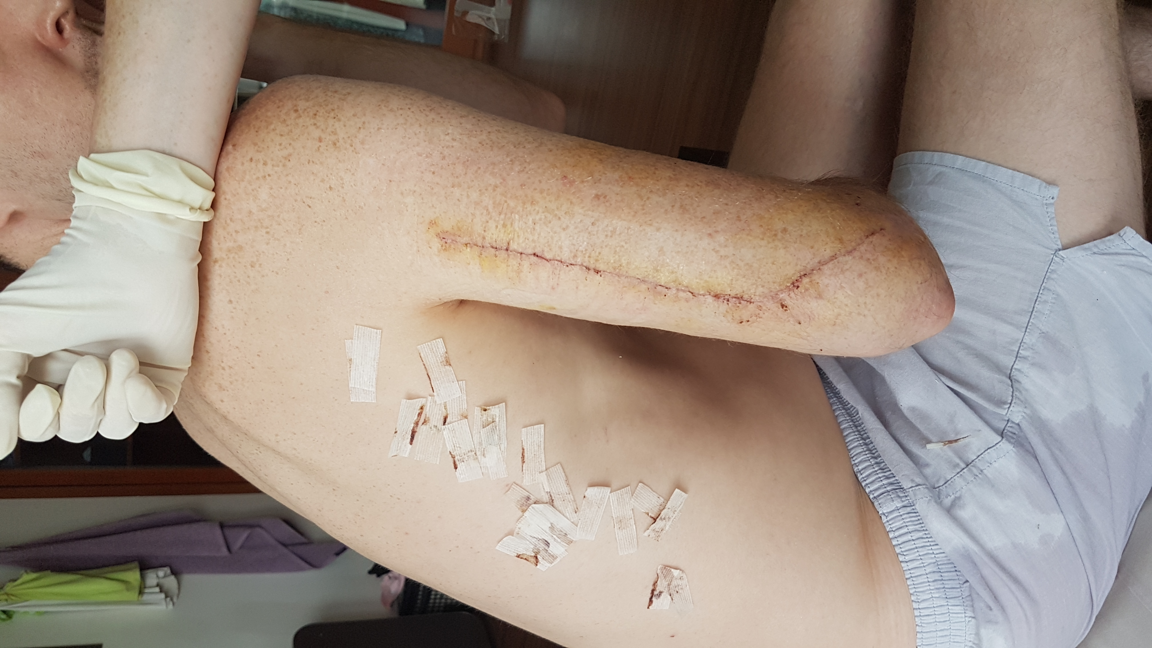 The arm — where the graft went in The arm — where the graft went in