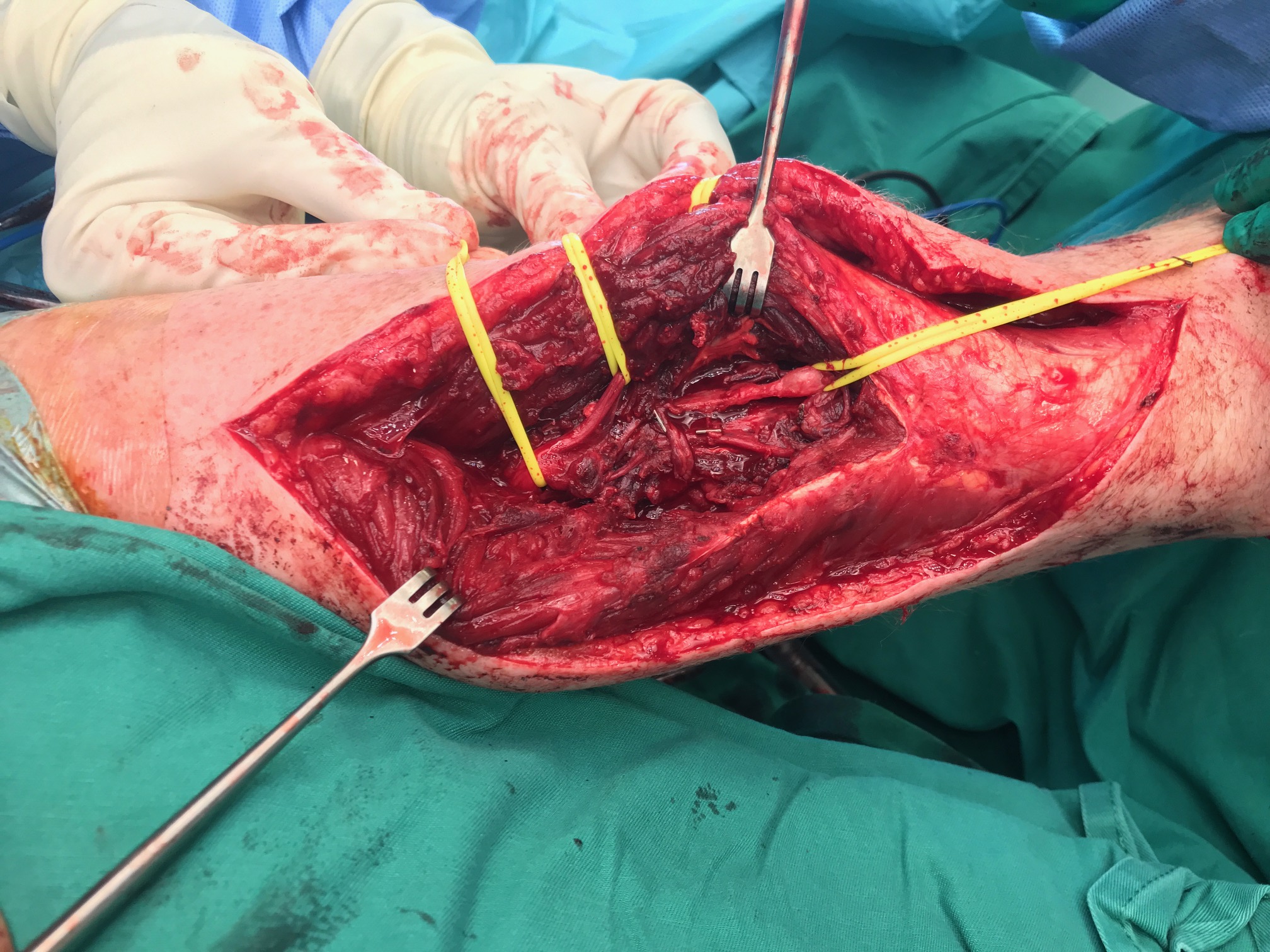 The radial nerve exposed — yellow loops mark it above and below the damage The radial nerve exposed — yellow loops mark it above and below the damage